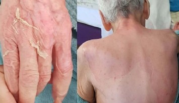 İzmir’de huzurevinde korkunç olay: Yaşlı kadının ölüm nedeni yanık ve buna bağlı komplikasyonlar çıktı