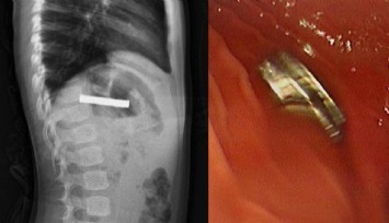 Çocuğun boğazından 19 adet mıknatıs çıkartıldı