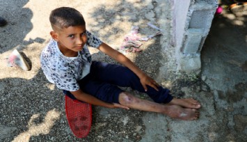 Kaza sonrası ayağı yanlış kaynadı, hayatı kaykay üzerinde geçiyor