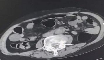 Denizli’de şaşırtan uyuşturucu operasyonu: Cinsel organında uyuşturucu sakladı