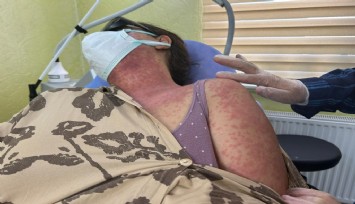 İntenetten krem alanlar dikkat: Beyazlatıcı krem nedeniyle 4 kişi hastanelik oldu