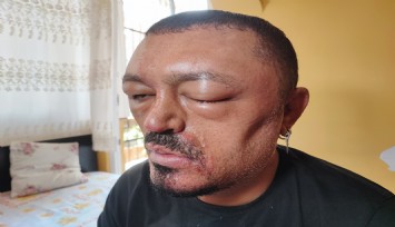 Adana’da saç siyahlaştırıcı şampuan dehşeti: Yüz ve gözünde yaralar oluştu