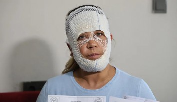 Adana’da güzellik kabusu: Prenses bakımı yüzünü yaktı, çocuğu korkup yaralandı