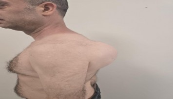 Sırtındaki 10 yıllık kitlenin içinden 1 buçuk kilogramlık tümör çıktı